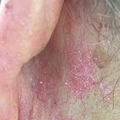 Close-up of irritated skin near the ear.
