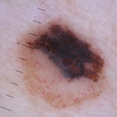 Skin lesion with irregular pigmentation and measurement.