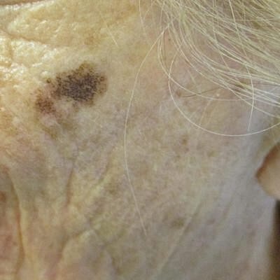 Close-up of skin with age spots.