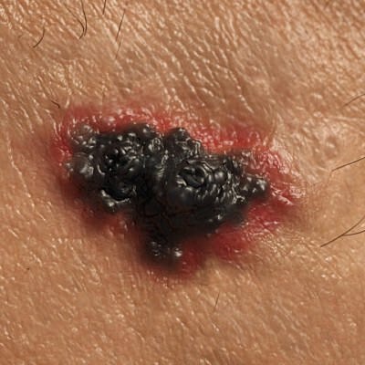 Skin lesion with dark, raised texture.