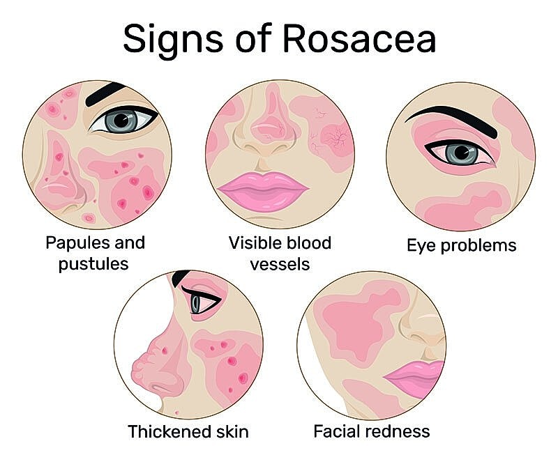 Signs and symptoms of rosacea illustrated visually.