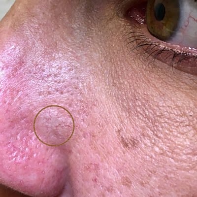 Close-up of skin with blemish highlighted.