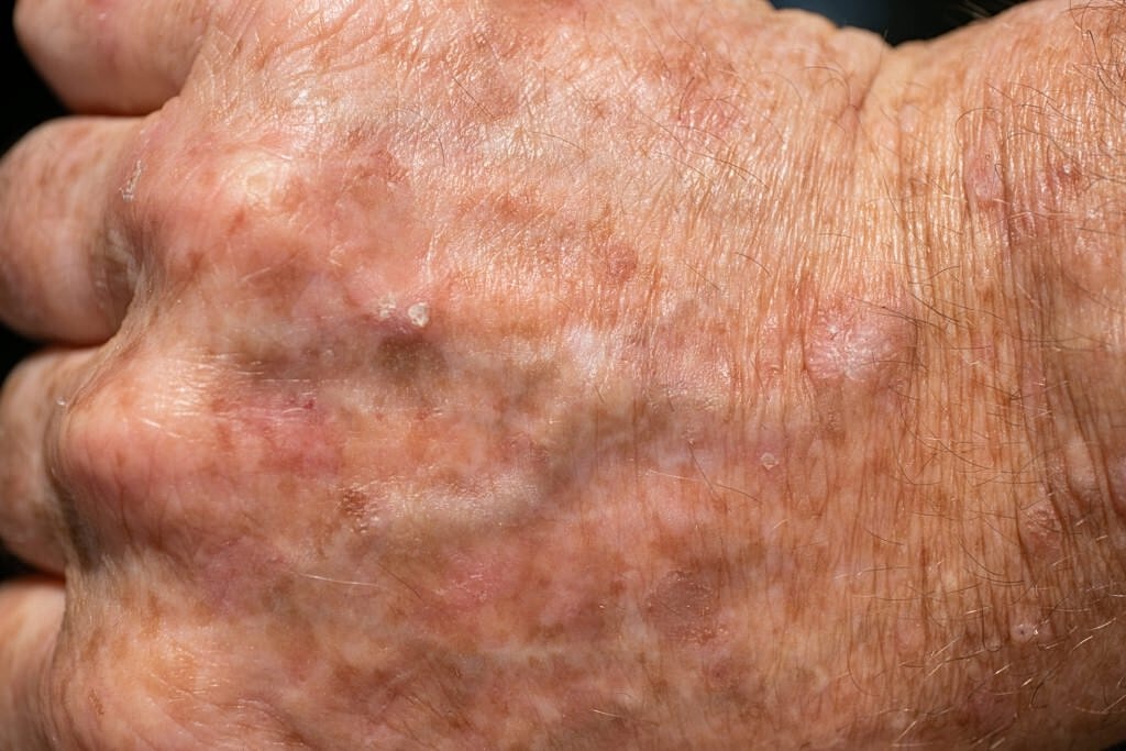 Close-up of textured skin on a hand.
