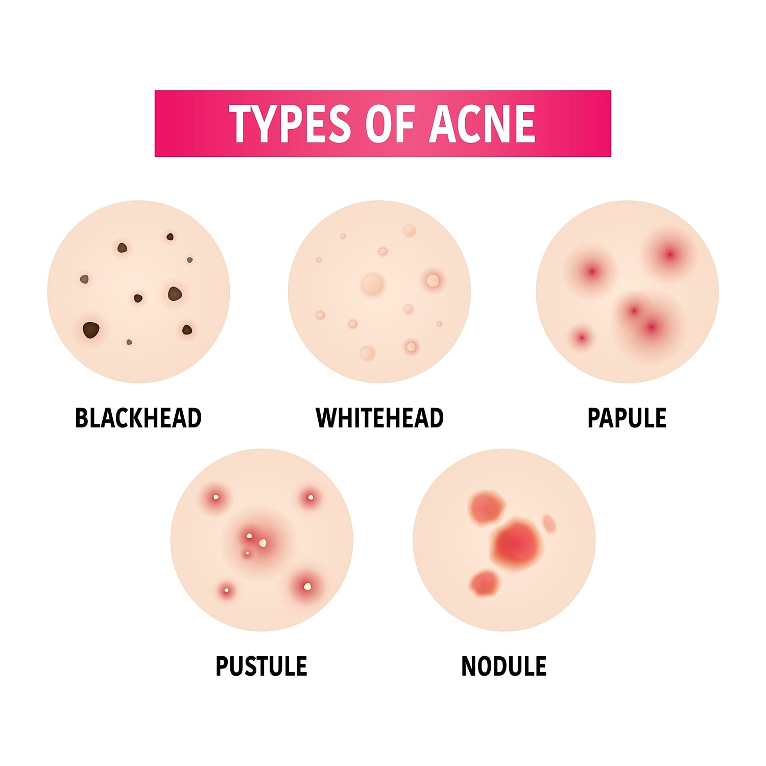 Types of acne: blackhead, whitehead, papule, pustule, nodule.