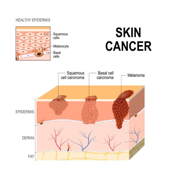 superficial spreading melanoma stages